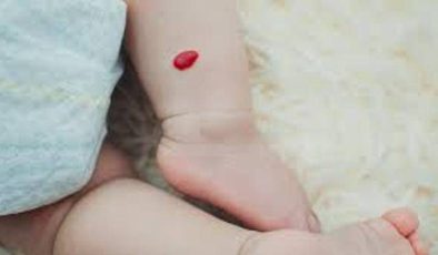 Hemanjiyom Prematüre Bebeklerde Daha Sık Görülüyor