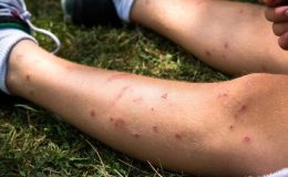 Böcek ısırması alerjileri bulgu ve belirtiler