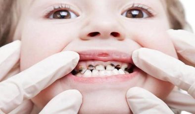 Çocuklar da Diş Çürüğü Neden Olur? Nelere Dikkat Edilmeli?
