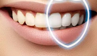 Diş beyazlatmanın yan etkileri