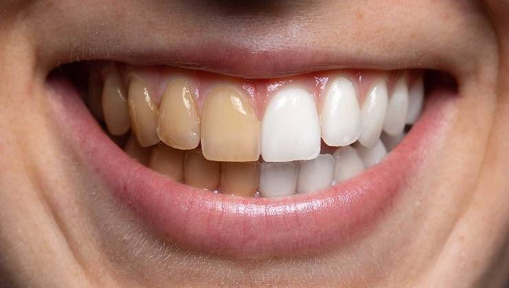 Diş lekelerinin tedavisinde uygulanan teknikler nelerdir?