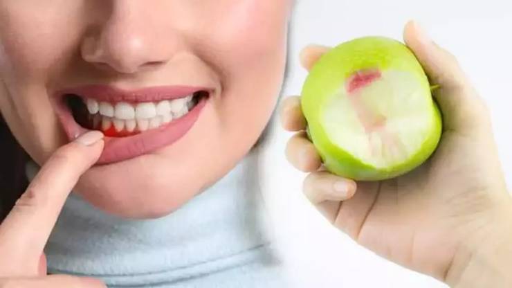Elma sirkesi ile Dişler Sağlıklı olsun