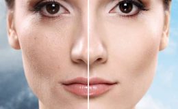 Gebelik Lekesi (Melasma)