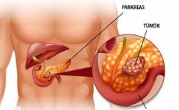 Pankreas Kanserinin Tedavisinde Cerrahinin Ve Girişimsel Radyolojinin Rolü