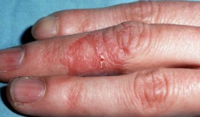 Temas dermatiti (kontak dermatit) bulgu ve belirtiler