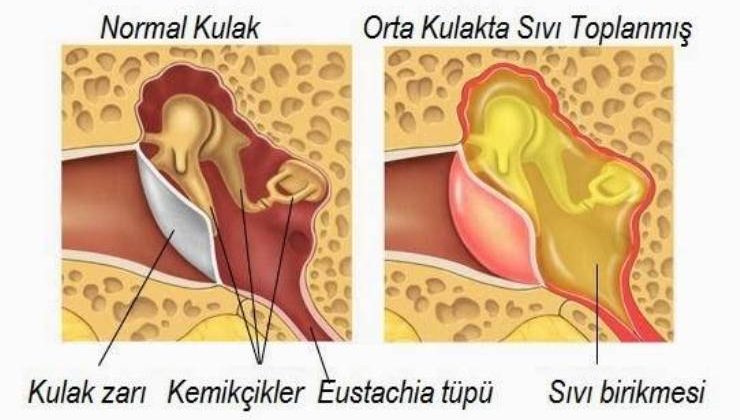 Efüzyonlu Orta Kulak İltihabı (Kulakta Sıvı)