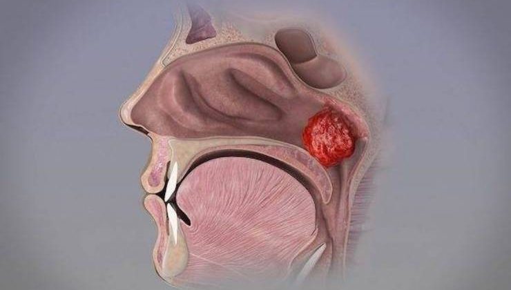 Geniz Eti (Adenoid Vejetasyon)