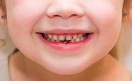Bebeklerde Diş Çürüğü – Biberon Çürüğü