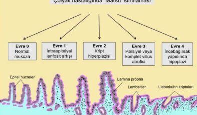 Çölyak Hastalığı: Gluten Enteropatisi