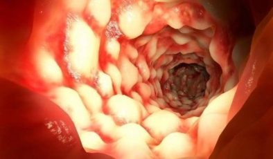 Crohn Hastalığı