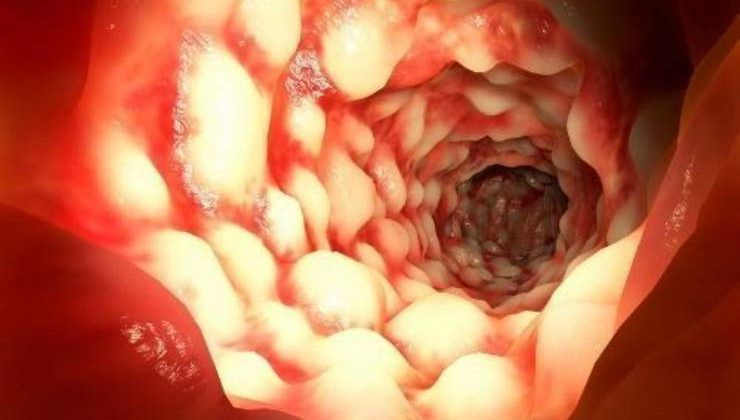 Crohn Hastalığı