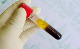 Fibrinojen Nedir ?