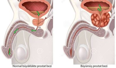 Prostat Tanısı ve Takibi