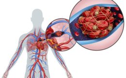 Pulmoner Emboli