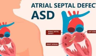 ASD Nasıl tedavi edilir?