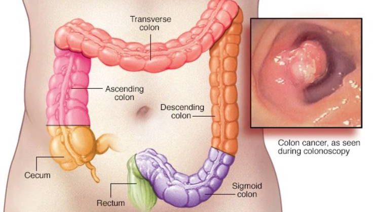 Kolorektal (Kalın Bağırsak ve Rektum) Kanseri