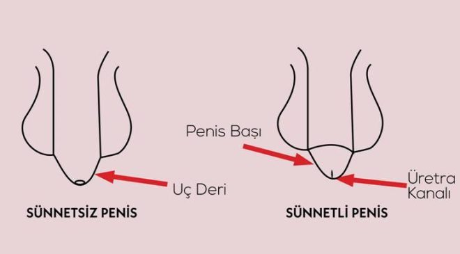 Sünneti cinsel travma olarak algılıyorlar