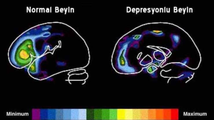 Depresyonda Beynin Görüntülenmesi