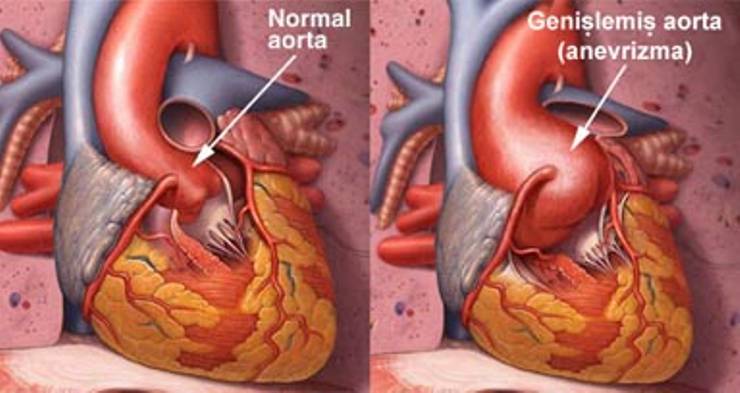 Abdominal Aort Anevrizmasında Nedenler, Şikayetler ve Tanı