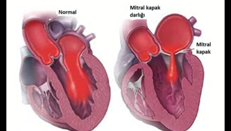 Mitral Darlığında Balonla Kapağı Genişletme Kriterleri