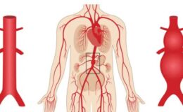 Abdominal Aort Anevrizmasında Tedavi