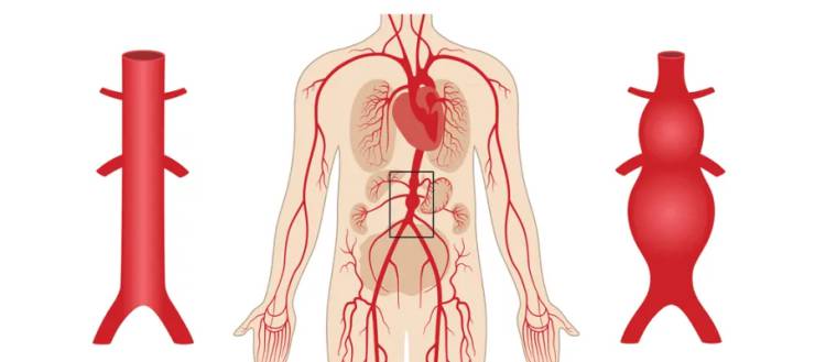 Abdominal Aort Anevrizmasında Tedavi