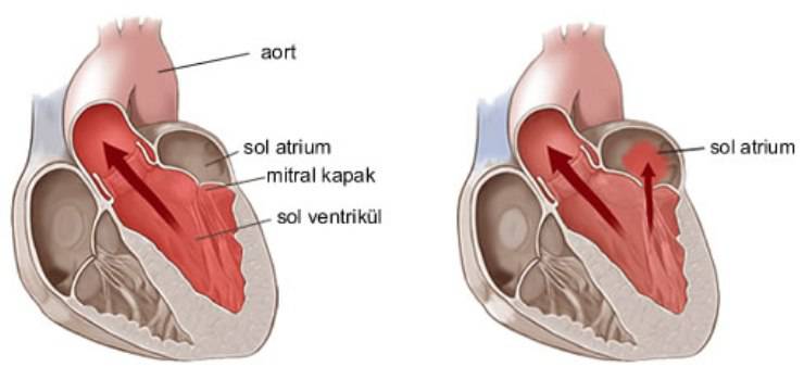 Mitral Kapak Hastalığı – Neden Olur?