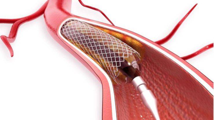 Ne zaman by-pass, ne zaman stent?