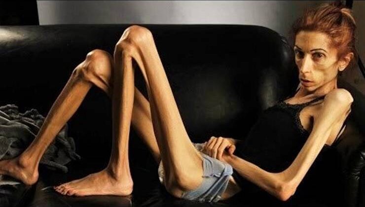 Anoreksia Mervosa (Kuruntulu İştahsızlık) ve Bulimia (Doymaz İştah Hastalığı)