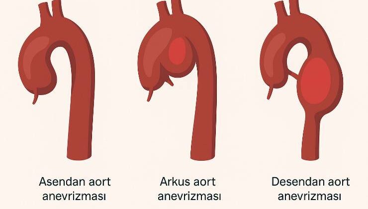 Aort anevrizması
