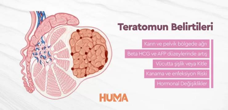 Teratom – Tedavi