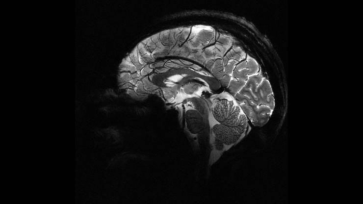 Yapay zeka, epilepsili çocuklarda doktorların gözden kaçırdığı gizli lezyonları buldu
