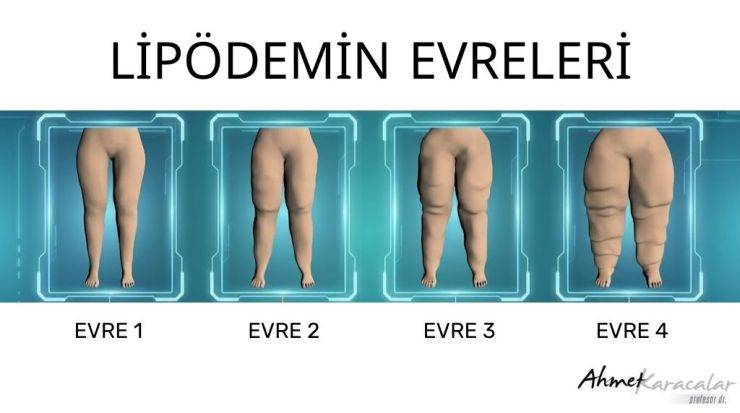 Kilo Veremiyorsanız Suçlu İradeniz Değil, LİPÖDEM Olabilir