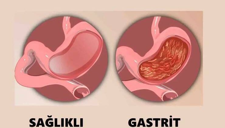 Gastrit Nedir – Gastrit Belirtileri Nelerdir