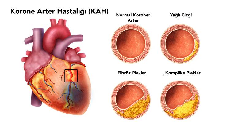 Koroner Arter Hastalıkları