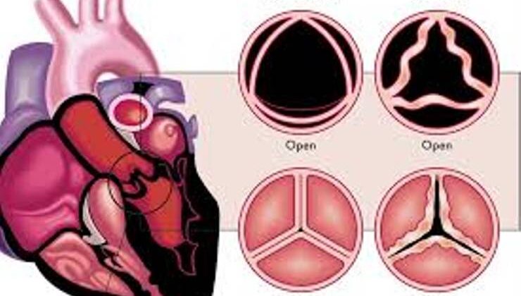 Mitral kapak düşüklüğü, Mitral kapak düşüklüğü Nedir?