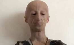 Progeria: 80 yaşındaki çocuk sendromu