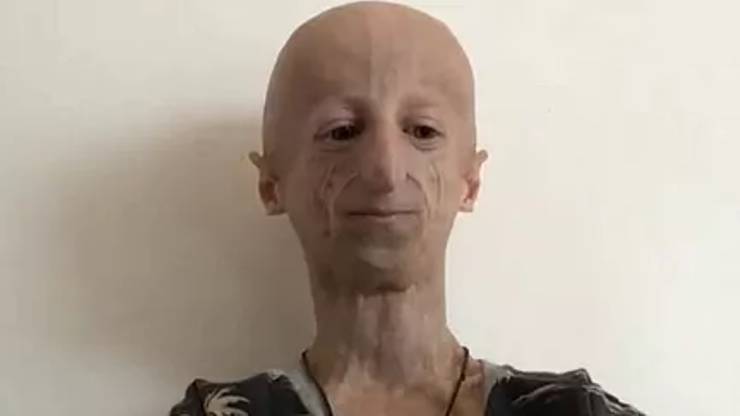 Progeria: 80 yaşındaki çocuk sendromu