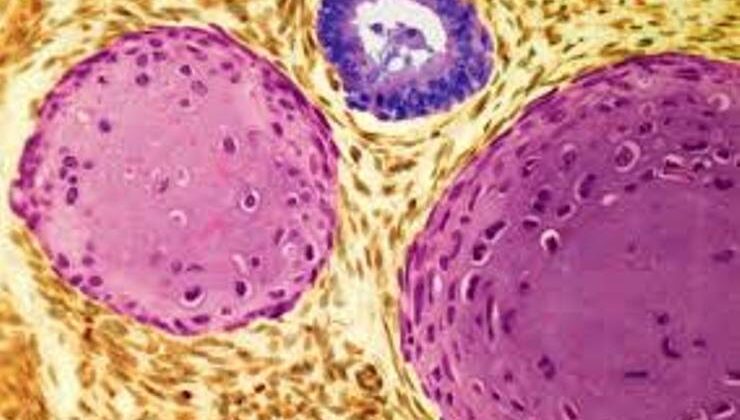 Teratom – Testler ve Komplikasyonlar