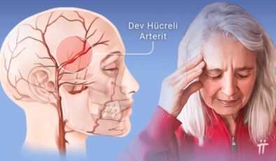 Dev hücreli arterit ve polymiyalgia romatika