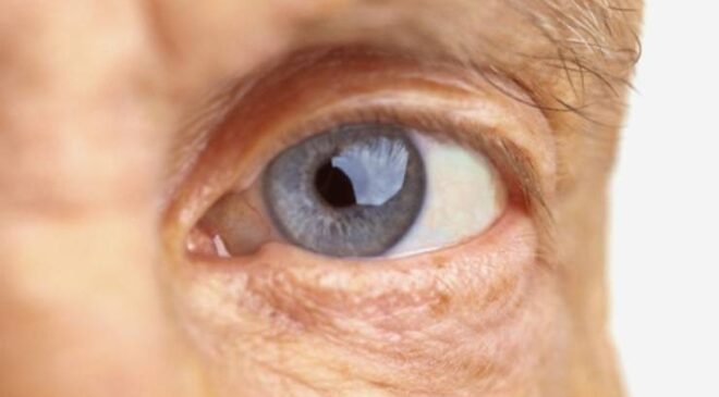 Şeker Hastalığı Gözü Nasıl Etkiler? Diyabetik Retinopati