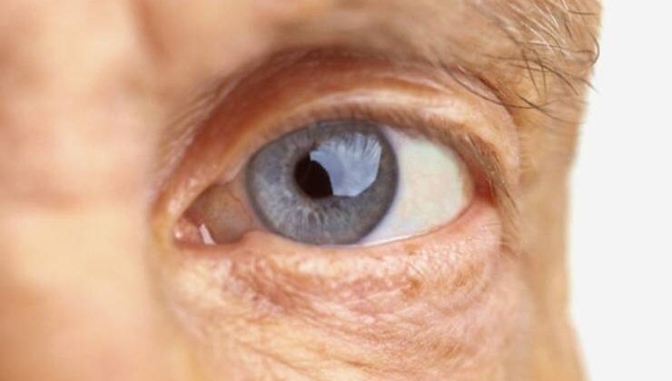 Diabetik Retinopati Şeker Hastalığında Göz