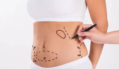 Liposuction İle İlgili Merak Edilenler