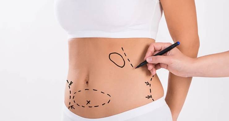Liposuction İle İlgili Merak Edilenler