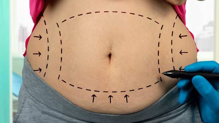 Liposuction (yağ aldırma)
