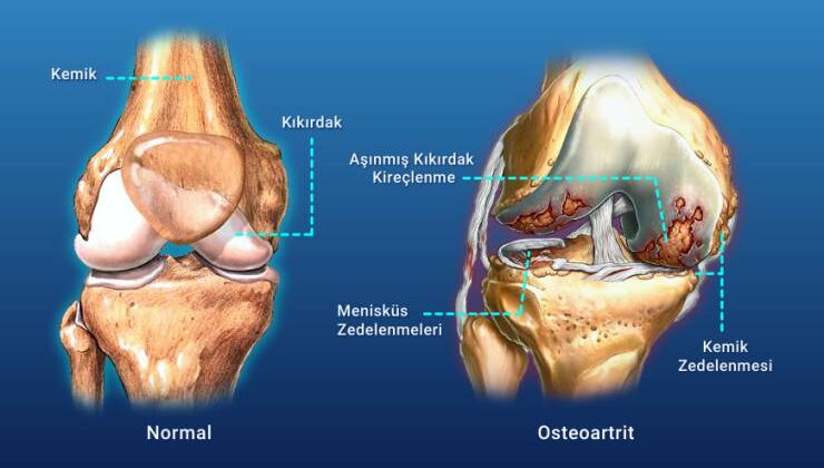 Osteoartrit – kireçlenme