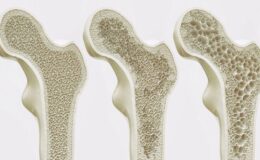Osteoporoz kemik erimesi