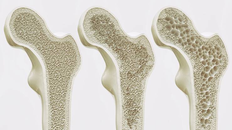 Osteoporoz kemik erimesi
