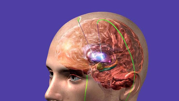 Parkinson Hastalığı Tedavisinde Beyin Pili Yöntemi