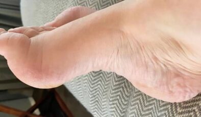 Charcot Marie Tooth Hastalığı Nedir? Belirtileri ve Tedavisi